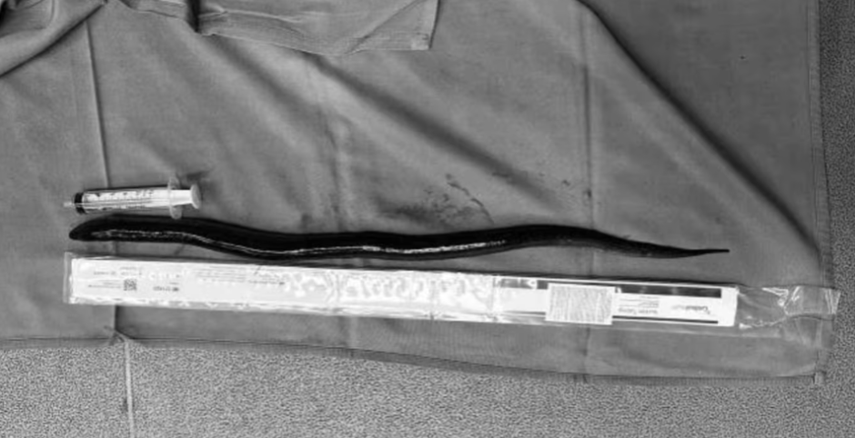 奇事!一名越南男子腹中竟有一条30公分活鳗鱼!